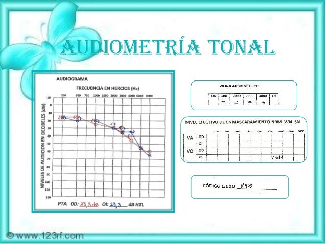 audiometria presbiacusia